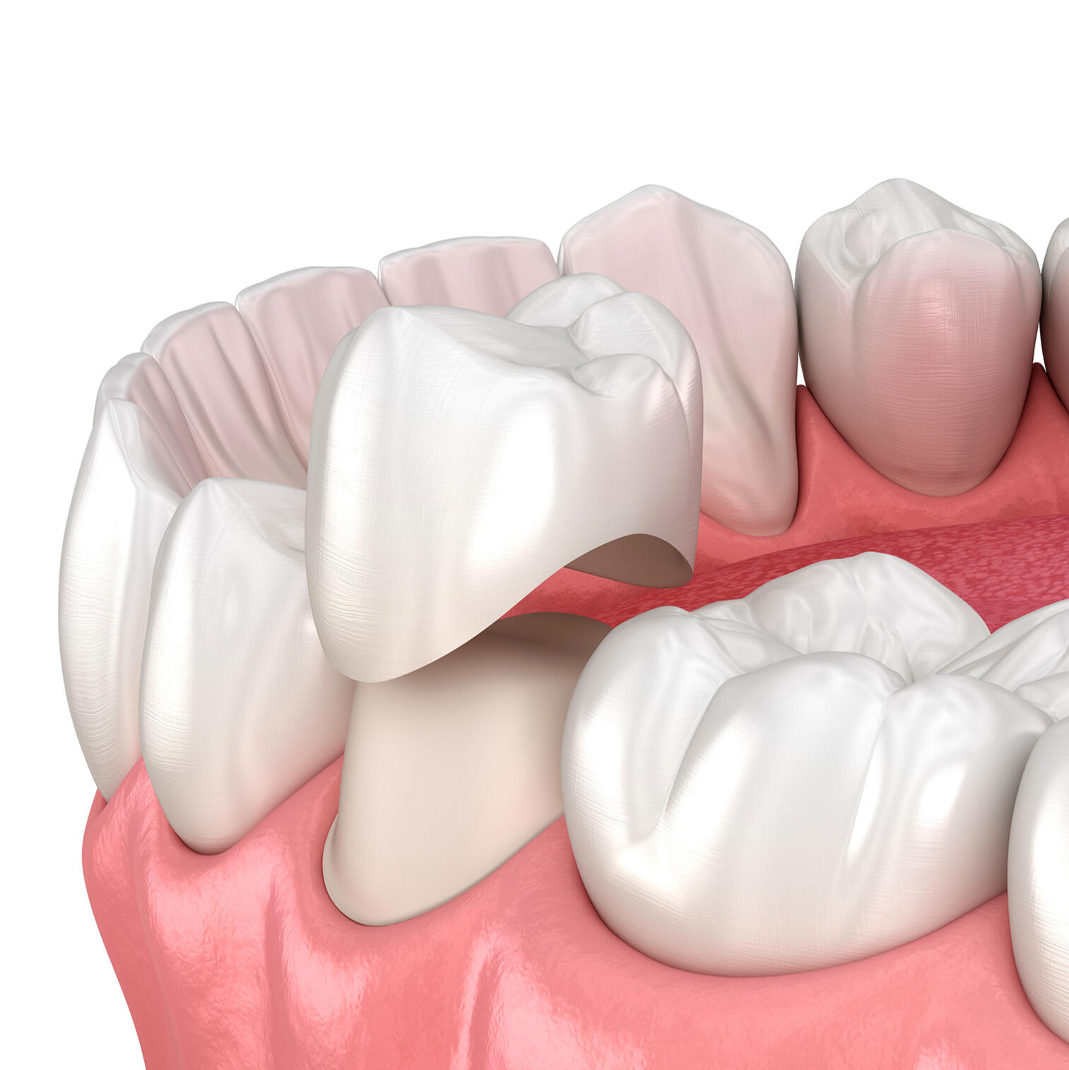 Prótesis dentales