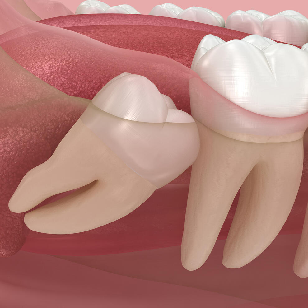 Cirugías dentales muelas del juicio. Dentisalud total